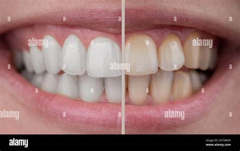 Close-up of a woman's smile before and after teeth whitening Stock ...