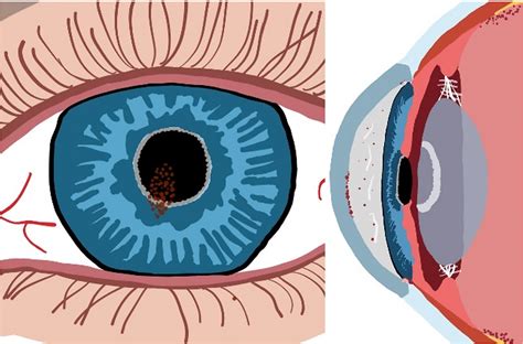 Pseudoexfoliation Syndrome Exfoliation Syndrome