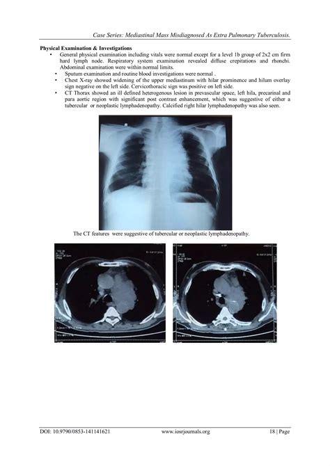 Case Series Mediastinal Mass Misdiagnosed As Extra Pulmonary Tuberculosis Pdf