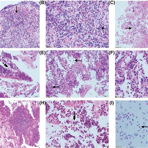 Pathology of bronchoscopic biopsy and pulmonary biopsy of chronic... | Download Scientific Diagram