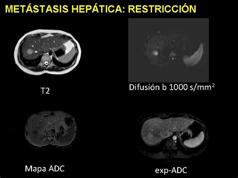 Mapa ADC El ADC Apparent Diffusion Coefficient Es