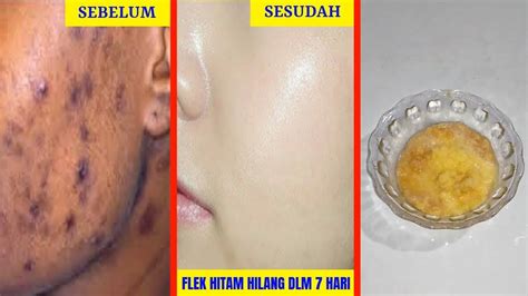 Cara Menghilangkan Flek Hitam Hanya Dalam 7 Hari Dengan Dua Langkah 100 Alami Youtube