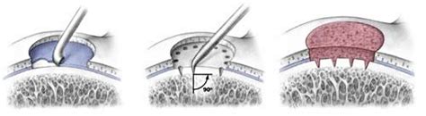 Microfracture Surgery Indications Recovery And Success Rate