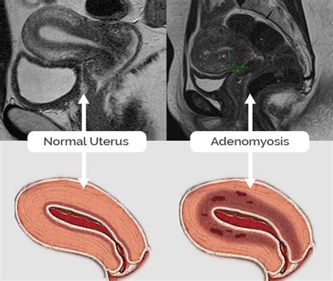 Adenomyosis SarenaEiddon