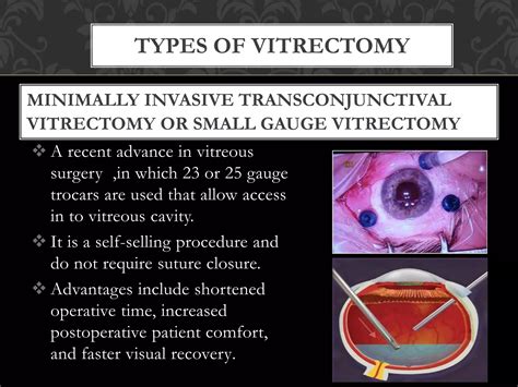 Types Of Vitrectomy Indication S And Complications Ppt