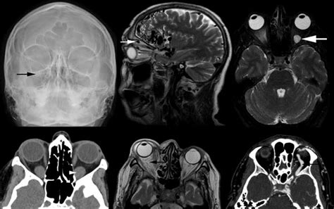 Imaging Of Adult Ocular And Orbital Pathology A Pictorial Review