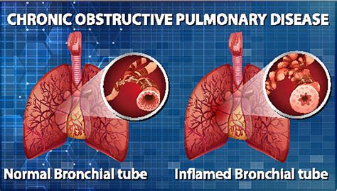 Chronic Obstructive Pulmonary Disease Lung Infographic Info Vector