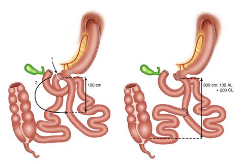 What To Expect From Single Anastomosis Duodenal Switch Body Point For Me