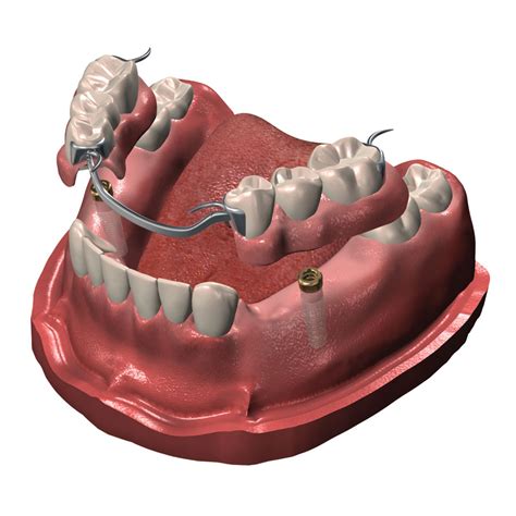 Implant Supported Partial Dentures