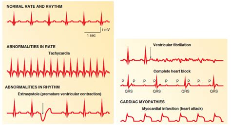 Ecg Abnormalities Chart Oficial Online Gbu