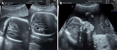 Apert Syndrome Diagnosed By Prenatal Ultrasound Combined With Magnetic