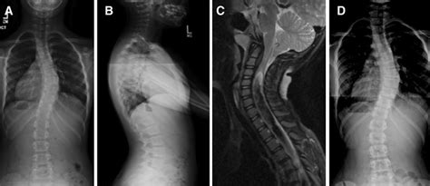 Outcomes Of Chiari I Associated Scoliosis After Intervention A Meta Analysis Of The Pediatric