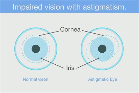 Astigmatismo qué es causas y síntomas Vision