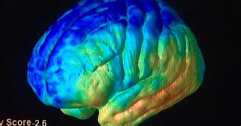 Chronic fatigue sufferers have brain abnormality, study says - CBS News