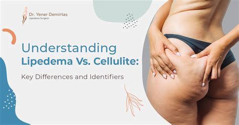 Understanding Lipedema Vs Cellulite Key Differences And Identifiers