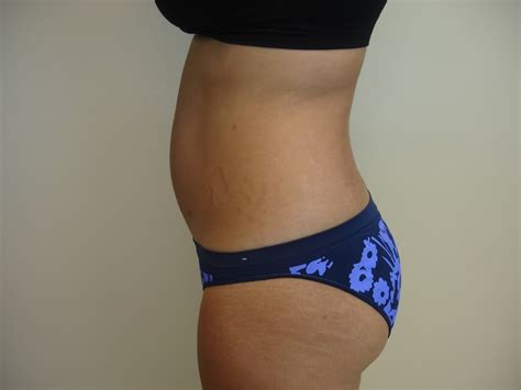 Dr BBL Specialist In Brazilian Butt Lifts And Fat Transfers