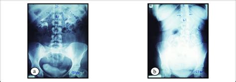 Intraveneous Urography Films Showing Patient A Supine And B Erect