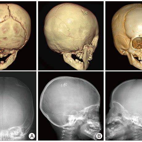 Depressed Skull Fracture In The Simple X Ray And Dimensional Computed