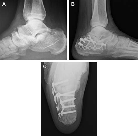 Surgical Treatment Of Intra Articular Calcaneal Fractures Clinics In