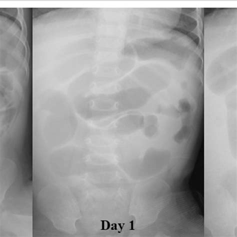 Abdominal X-ray findings | Download Scientific Diagram