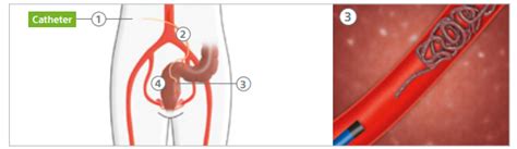 Hemorrhoid Artery Embolization Georgia Vascular Institute