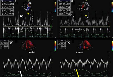 Noninvasive Multimodality Imaging For The Diagnosis Of Constrictive Pericarditis Circulation