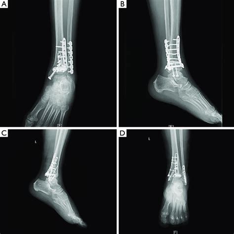 Postoperative X-ray in the control group. In the early stage of... | Download Scientific Diagram