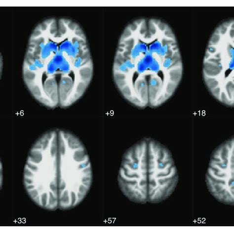 Statistical Parametric Map Overlaid On An MRI Template Neurological