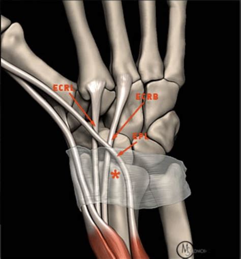 Distal Intersection Syndrome Injection Wikism Sports Medicine Wiki