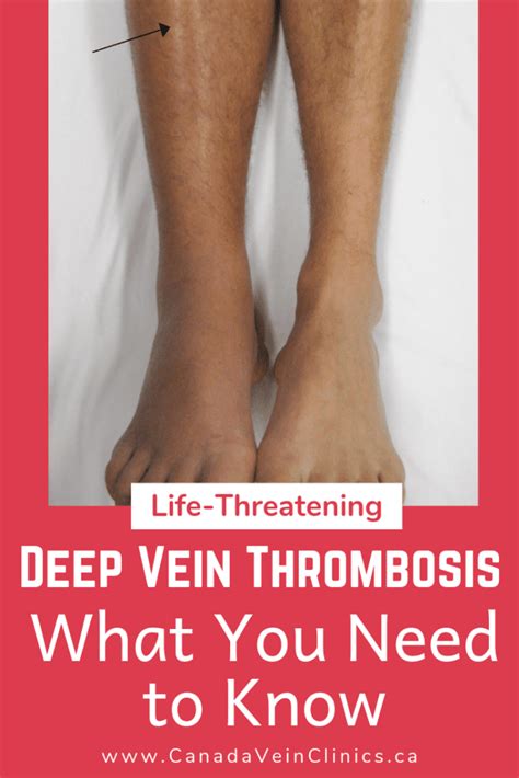 Deep Vein Thrombosis (DVT): Complications of Varicose Veins | Canada ...