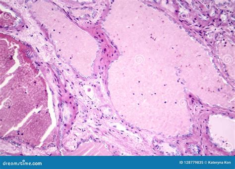 Hepatic Cavernous Hemangioma Stock Image Image Of Cavernous Benign