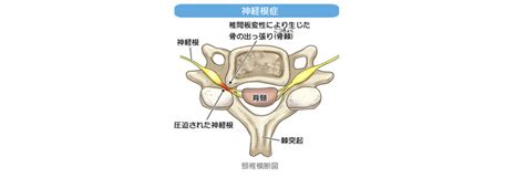 頚椎神経根症手術レポ その1（診断編） 開業歯科医院経営夫婦のひとりごと