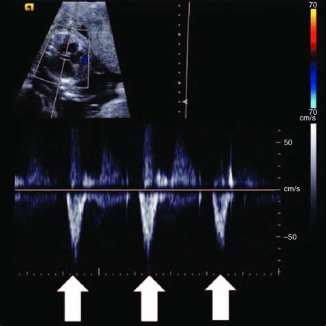 Pulsed Wave Doppler Evaluation Of Mitral Valve Inflow The Doppler