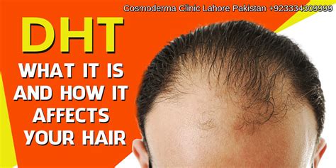 Male Pattern Baldness Male Sex Hormone Dht Cause Androgen Alopecia