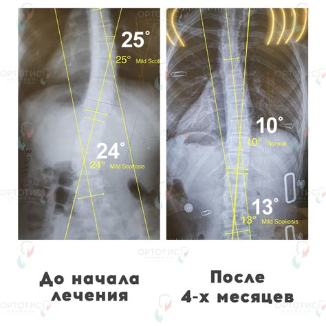 Результаты сколиоз фото 21 - Ортотис Премиум