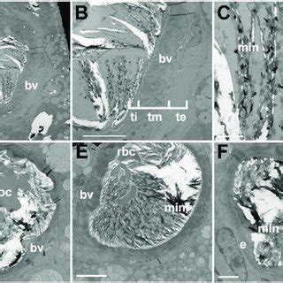 calcified lesions   vasculature  scientific diagram
