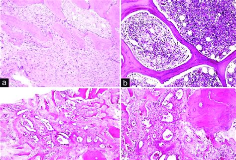 osteoblastic pattern     mixed pattern     osteoid