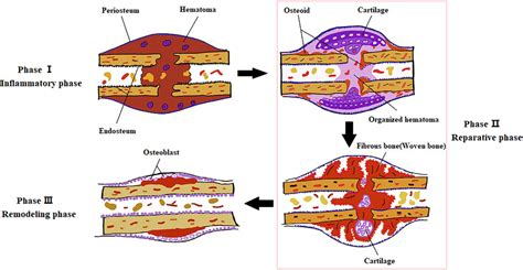 Computational Models Of Bone Fracture Healing And Applications A Review