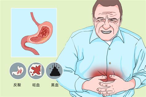 糜烂性胃炎 有来医生