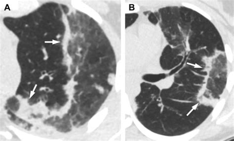 Imaging Of Eosinophilic Lung Diseases Radiologic Clinics