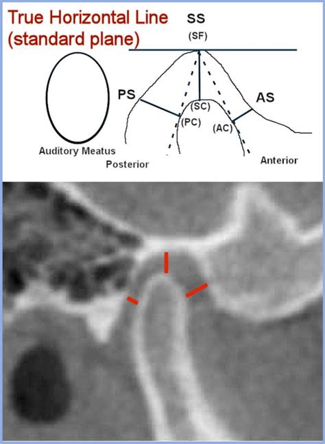 The Method Of Measurement Of Condylar Position Within The Fossa Download Scientific Diagram