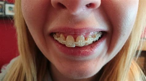 5 6 Month Update On Journey With Braces As An Adult Adult Braces 6