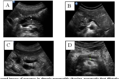 Figure 3 From Ultrasound Assessment Of Pancreatitis In Paediatric