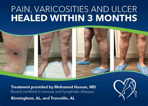 Why You Should Never Ignore Your Varicose Veins A Patients Story