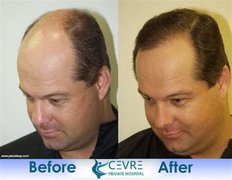 Before and After Hair Transplantation | Turkey FUE Istanbul