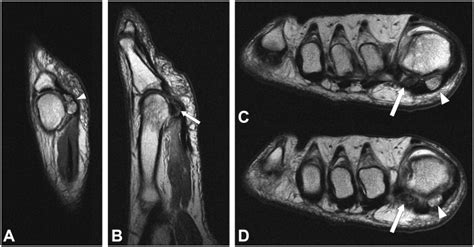 Forty Year Old Runner With Sesamoid Injury Sagittal A B And Axial