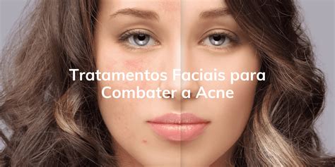 Tratamentos Faciais Para Combater A Acne Clinica Humanit