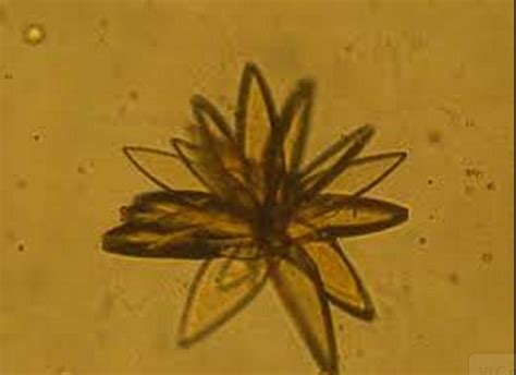 Variations of Uric acid crystals in urine | Medical Laboratories