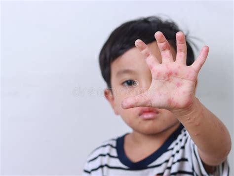 Boy Suffering From Hand Foot And Mouth Disease Showing Hand With Rash