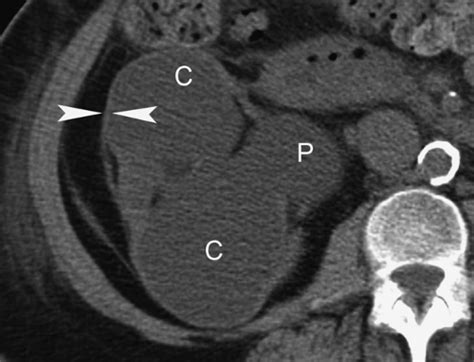 Pelvicalyceal System Ureters Bladder And Urethra Radiology Key